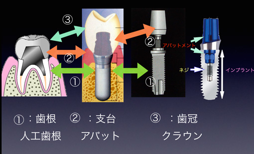 図３：インプラントの構造３