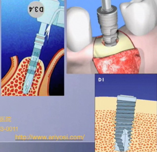 図１：インプラント埋入