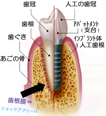 図１：インプラントの構造１