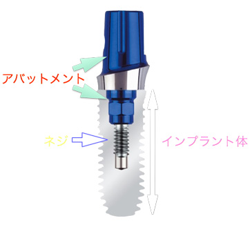 図２：インプラントの構造２