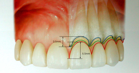 歯茎の前面と隣の歯との境界で高さに差がある