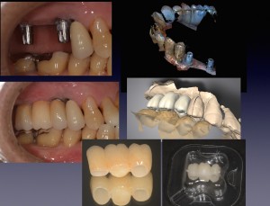 インプラントブリッジ２